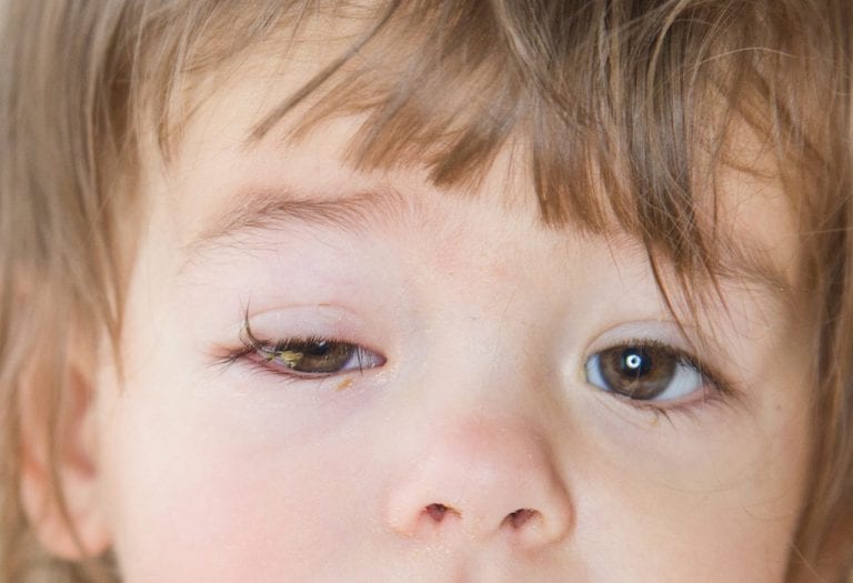 التهاب الملتحمة عند الاطفال (العين الوردية) - %categories
