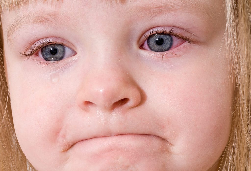 التهاب الملتحمة عند الاطفال (العين الوردية) - %categories