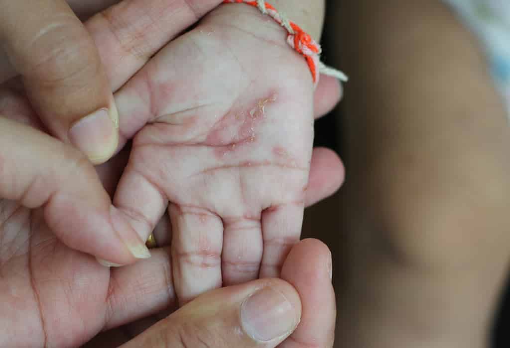 10 أمراض شائعة في موسم الأمطار لدى الرضع والأطفال - %categories