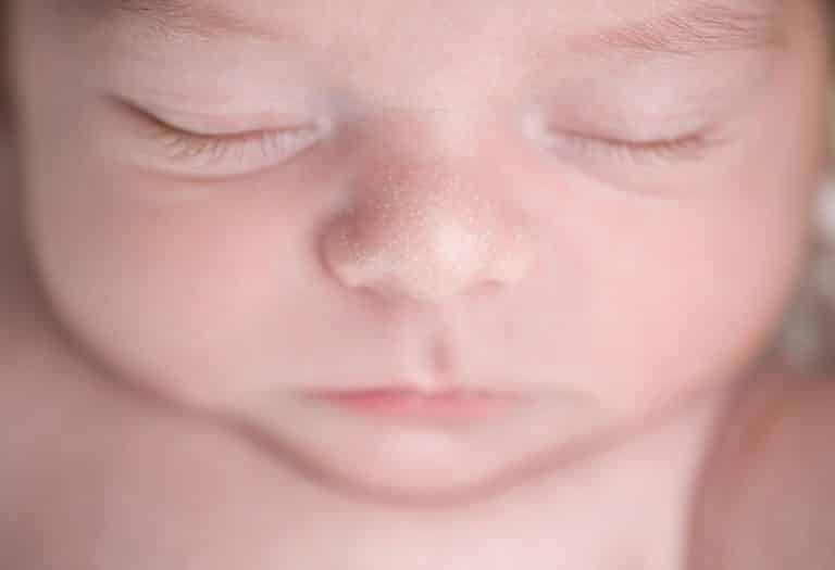 الدخينات (حبوب الميليا)  لدى حديثي الولادة والأطفال - أنواع ، الأسباب والعلاج - %categories