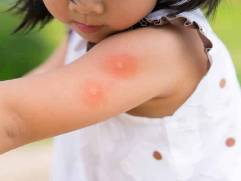 اعراض حمى الضنك عند الأطفال - العلامات والتشخيص والعلاج - %categories