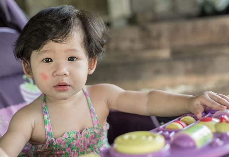 العلاجات المنزلية لإزالة بقع بيضاء على وجه الأطفال والرضع - %categories