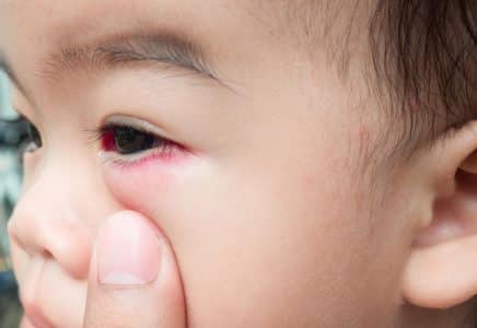 التهابات العيون عند الأطفال - الأنواع والأعراض والعلاج - %categories