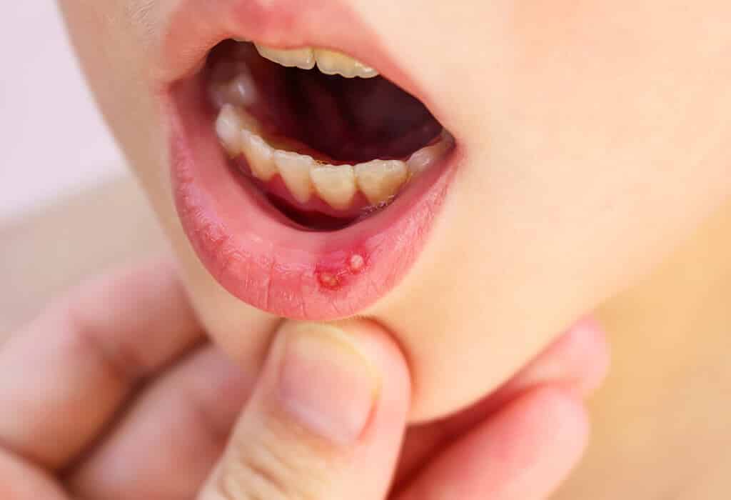 قرحة الفم عند الرضع والأطفال - %categories