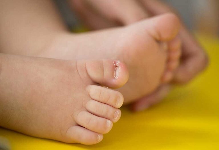 نمو أظافر أصابع القدم تحت الجلد عند الأطفال - الأسباب والأعراض والعلاجات - %categories
