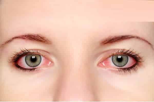 العلاجات المنزلية لإحمرار العين أحلى هاوم