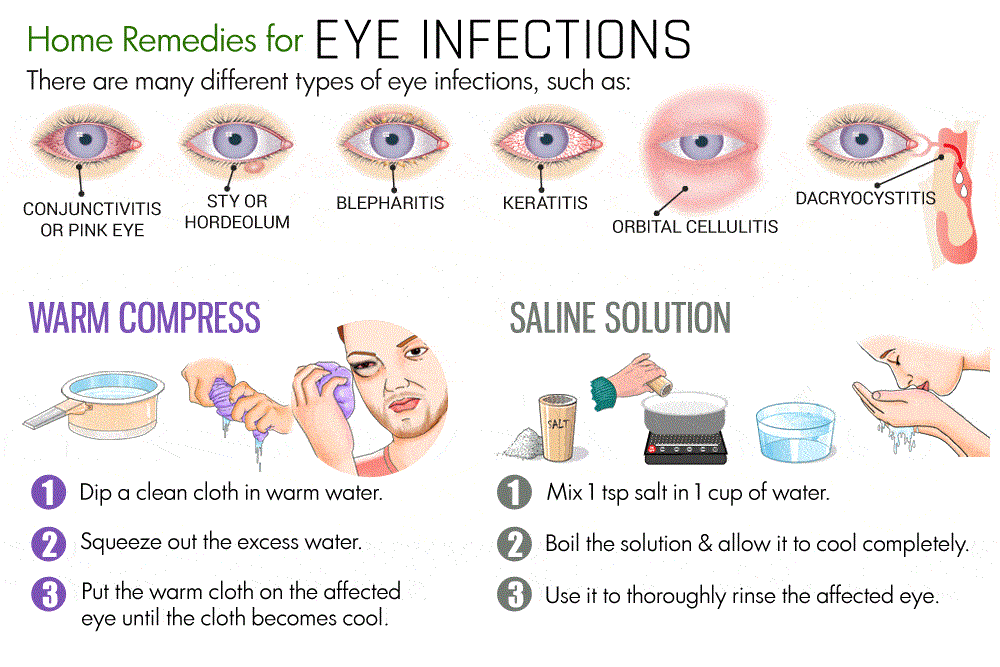 العلاجات المنزلية لالتهابات العين - %categories