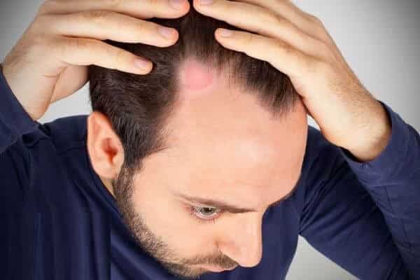 العلاجات المنزلية لمكافحة سعفة الرأس - %categories