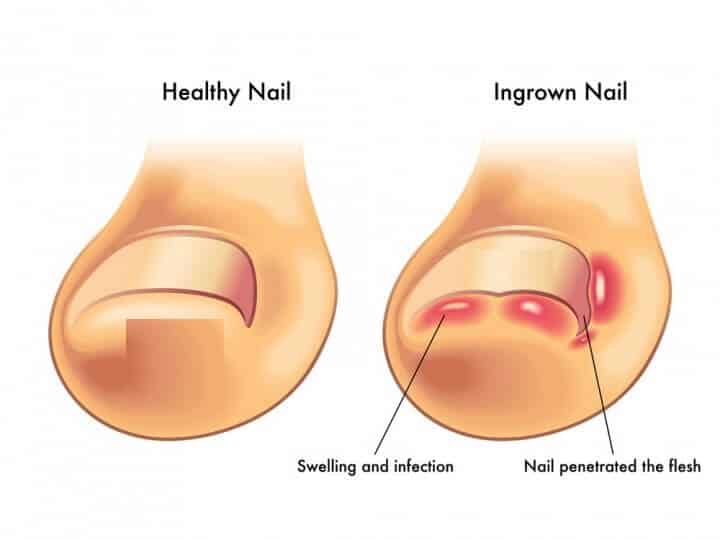 العلاجات المنزلية لانغراس الظفر في أصابع الأقدام - %categories