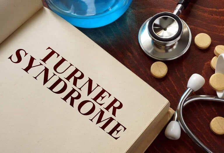 ما هي متلازمة تيرنر ؟ - الأعراض والأسباب والعلاج - %categories