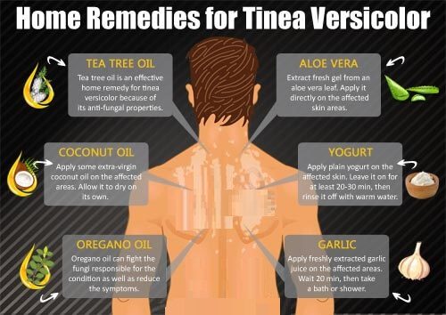 السعفة المبرقشة و علاجها الطبيعي - skin-beauty tinea versicolor 500 - السعفة المبرقشة و علاجها الطبيعي