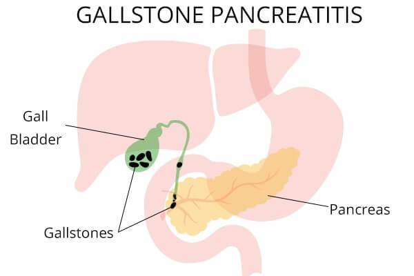 gallstones pancreatitis anatomy 1 - فهم التهاب البنكرياس بسبب حصى المرارة