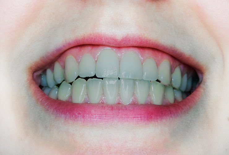 الأسنان الرمادية: الأسباب والعلاج والرعاية الذاتية والمضاعفات - %categories