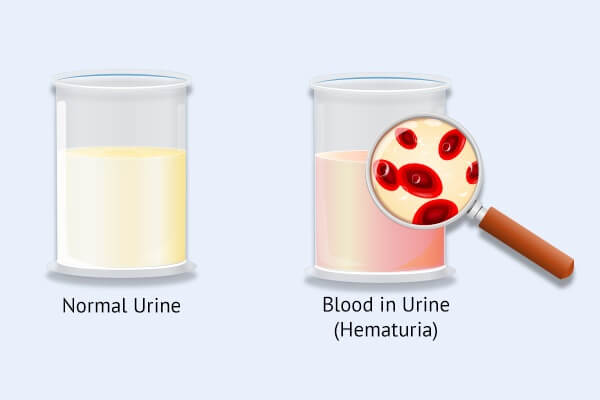 ما هي أسباب البيلة الدموية (الدم في البول) وكيفية علاجها - %categories
