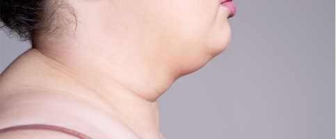 Exercices, régime et poses pour réduire l'excès de graisse du cou - skin-beauty Neck Fat Feat - Exercices, régime et poses pour réduire l'excès de graisse du cou