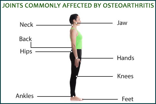 علاج الفصال العظمي : النظام الغذائي والرعاية الذاتية والعلاج الطبي - bones-joints osteoarthritis joints are affected - علاج الفصال العظمي : النظام الغذائي والرعاية الذاتية والعلاج الطبي
