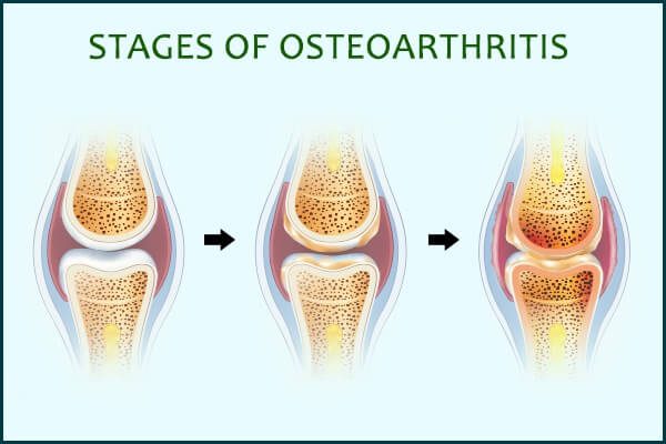 علاج الفصال العظمي : النظام الغذائي والرعاية الذاتية والعلاج الطبي - bones-joints osteoarthritis progress - علاج الفصال العظمي : النظام الغذائي والرعاية الذاتية والعلاج الطبي
