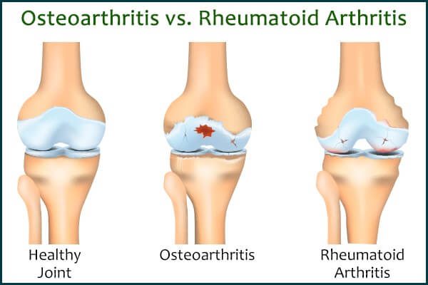 علاج الفصال العظمي : النظام الغذائي والرعاية الذاتية والعلاج الطبي - bones-joints osteoarthritis versus rheumatoid arthritis - علاج الفصال العظمي : النظام الغذائي والرعاية الذاتية والعلاج الطبي