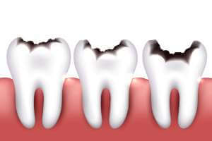 نخر الاسنان-التجويف : الاسباب , الاعراض , الوقاية , العلاج - %categories