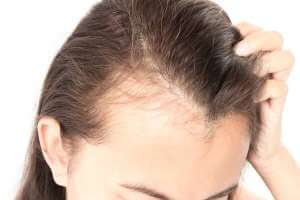成人の脱毛症、原因、脱毛症に対する最良の自然療法 - %categories
