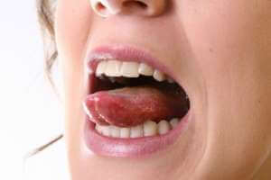 بثور اللسان , اسبابها , نصائح وطرق منزلية فعالة لعلاجها - oral-health اللسان اسبابها نصائح وطرق منزلية فعالة لعلاجها3 1 - بثور اللسان , اسبابها , نصائح وطرق منزلية فعالة لعلاجها