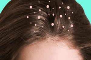 صودا الخبز لعلاج قشرة الرأس , أفضل الطرق لاستخدام صودا الخبز للقشرة - skin-beauty الخبز لعلاج قشرة الرأس أفضل الطرق لاستخدام صودا الخبز للقشرة3 1 - صودا الخبز لعلاج قشرة الرأس , أفضل الطرق لاستخدام صودا الخبز للقشرة