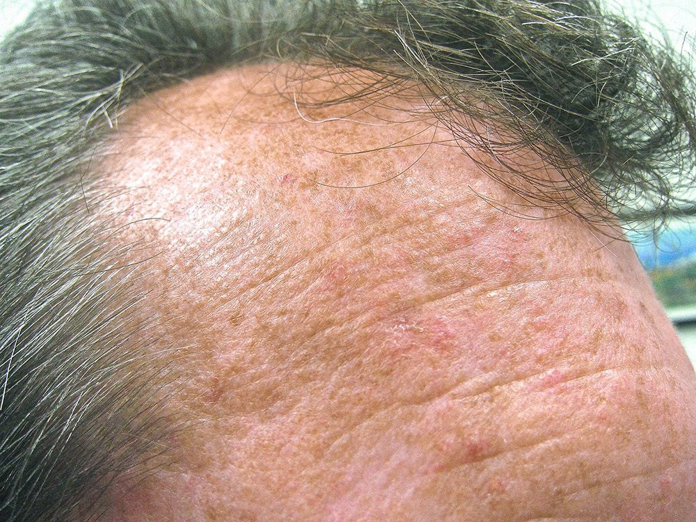 ما الذي يسبب التقران السفعي وكيفية علاجه؟ - skin-beauty actinic keratoses forehead picture - ما الذي يسبب التقران السفعي وكيفية علاجه؟