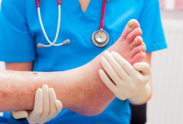 من يصاب بالتهاب النسيج الخلوي وكيفية علاجه؟ - skin-beauty cellulitis feat - من يصاب بالتهاب النسيج الخلوي وكيفية علاجه؟