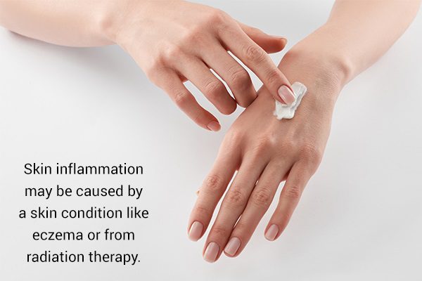 من يصاب بالتهاب النسيج الخلوي وكيفية علاجه؟ - skin-beauty cellulitis skin conditions or disorders - من يصاب بالتهاب النسيج الخلوي وكيفية علاجه؟