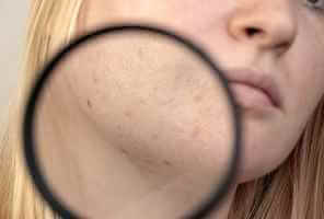 ما هي أسباب وخيارات العلاج الطبي للبقع الداكنة - skin-beauty dark spots on face لfeat - ما هي أسباب وخيارات العلاج الطبي للبقع الداكنة