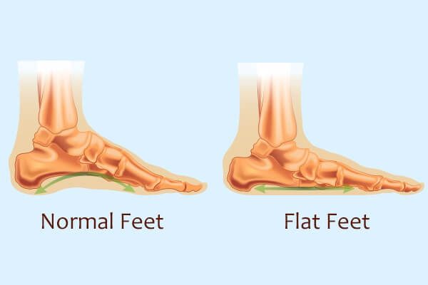 جراحة القدم المسطحة: نصائح التحضير والمخاطر والتعافي - bones-joints flat foot surgery medical treatments - جراحة القدم المسطحة: نصائح التحضير والمخاطر والتعافي