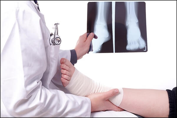 ماذا تتوقع من جراحة استبدال الكاحل؟ - bones-joints process of ankle replacement surgery - ماذا تتوقع من جراحة استبدال الكاحل؟