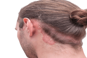 التهاب الجلد الدهني أو الأكزيما الدهنية , الاسباب, العلاجات المنزلية - skin-beauty الجلد الدهني أو الأكزيما الدهنية الاسباب العلاجات المنزلية3 1 - التهاب الجلد الدهني أو الأكزيما الدهنية , الاسباب, العلاجات المنزلية