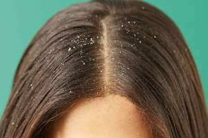 القشرة في الشعر في فصل الشتاء , الاسباب وطرق طبيعية لعلاجها - %categories
