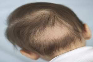 تساقط الشعر عند الاطفال , هل هي مشكلة طبيعية ام مرض - %categories