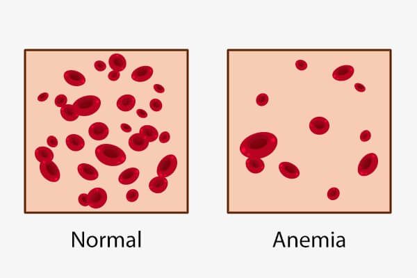 كيف تعرف إذا كنت تعاني من فقر الدم؟ وكيفية التعامل معه؟ - heart-health anemia types - كيف تعرف إذا كنت تعاني من فقر الدم؟ وكيفية التعامل معه؟