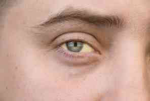 ما الذي يسبب اليرقان وكم يستمر عادة؟ - infectious-diseases jaundice pitcسhes feat 1 - ما الذي يسبب اليرقان وكم يستمر عادة؟