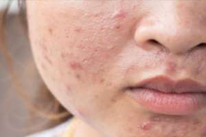 الخيار لعلاج حب الشباب - طرق ونصائح عملية لأستخدامه - skin-beauty 5aa30838782fde34008b45bf 1 - الخيار لعلاج حب الشباب - طرق ونصائح عملية لأستخدامه