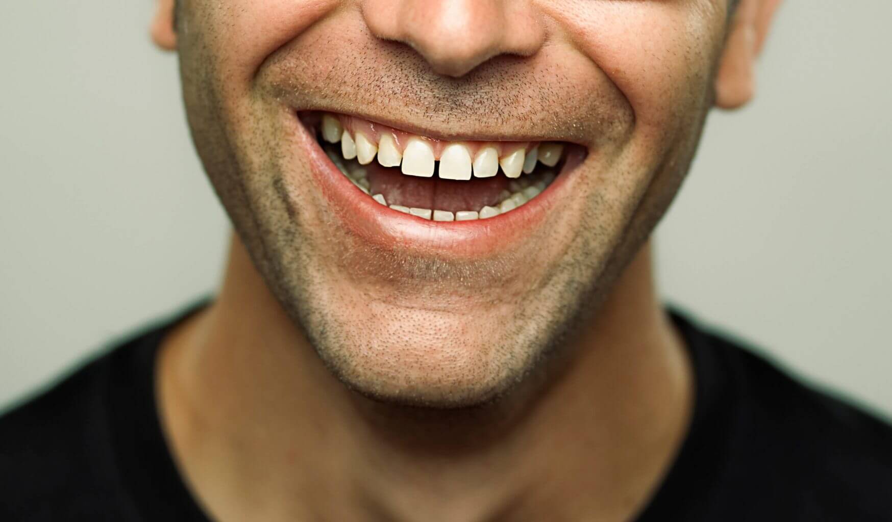 فلج الأسنان (فجوة بين الأسنان): الأسباب والعلاج - %categories