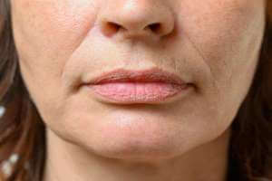 التجاعيد حول الفم , طرق منزلية فعالة للتخلص منها و بدون جراحة