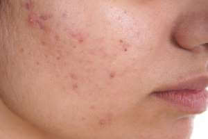 الخيار لعلاج حب الشباب - طرق ونصائح عملية لأستخدامه - skin-beauty acne 1 1 - الخيار لعلاج حب الشباب - طرق ونصائح عملية لأستخدامه