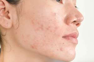 الخيار لعلاج حب الشباب - طرق ونصائح عملية لأستخدامه - skin-beauty gettyimages 851423236 1558637428 1 - الخيار لعلاج حب الشباب - طرق ونصائح عملية لأستخدامه