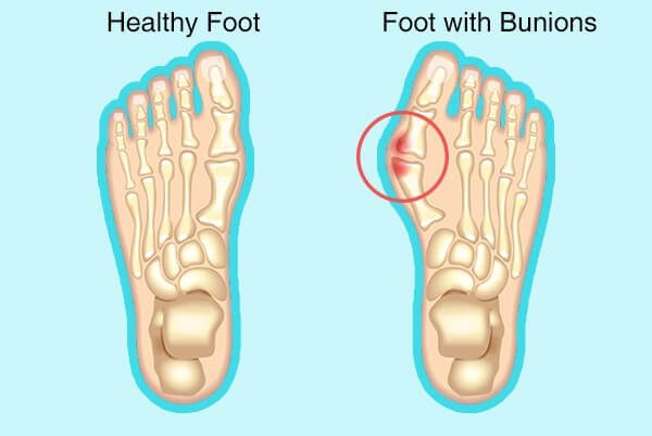 الوكعات (انحراف إصبع القدم الكبير) : الأسباب والأعراض والعلاج الطبي - %categories