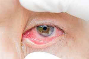 Wie man rosa Augen zu Hause beruhigt 27565212 82b50463 image a 8 1587682289332 - So lindern Sie Bindehautentzündungen zu Hause