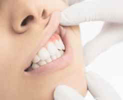 الرعاية الذاتية والعلاجات المنزلية لالتهاب اللثة - oral-health What is gingiviftis - الرعاية الذاتية والعلاجات المنزلية لالتهاب اللثة