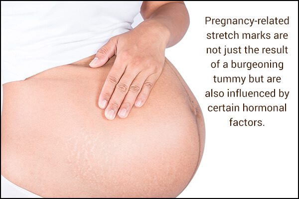 Qué causa las estrías del embarazo y cómo evitarlas - %categorías