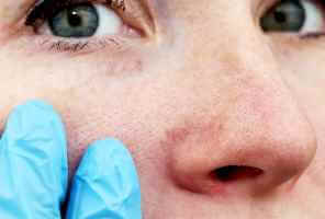 Lupus: Änderungen des Lebensstils und Krankheitsmanagement – Allergie-Immunität Lupus ferrerat 1 - Lupus: Lebensstiländerungen und Krankheitsmanagement