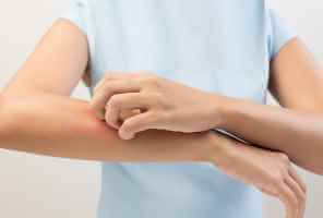 Lupus-Typen, Symptome und Exazerbationen - Allergie-Immunität Lupus-Typen Febesis - Arten, Symptome und Exazerbationen von Lupus