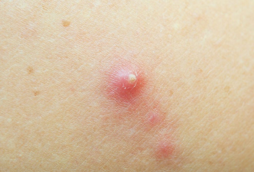 Forúnculos y abscesos síntomas, tratamiento definitivo y