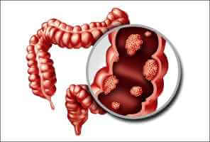 فحص سرطان القولون: من يجب فحصه وكيف - digestive-health colon cancer screening ؤسfeat - فحص سرطان القولون: من يجب فحصه وكيف